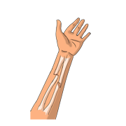 broken bone
